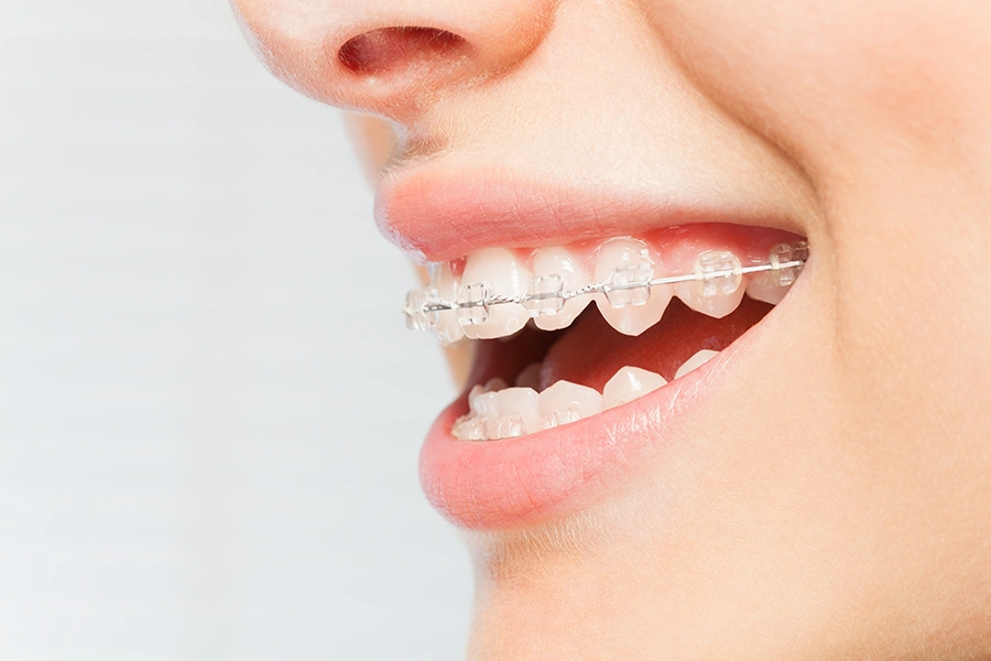 Close-up of a smiling mouth with clear ceramic braces on white teeth.