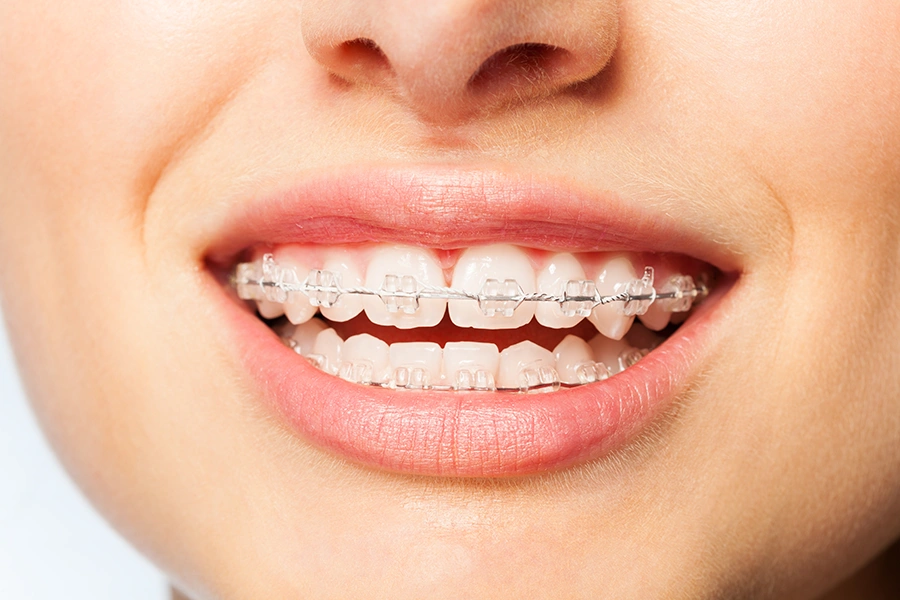 Close-up of a smiling person wearing clear ceramic braces on their upper and lower teeth.