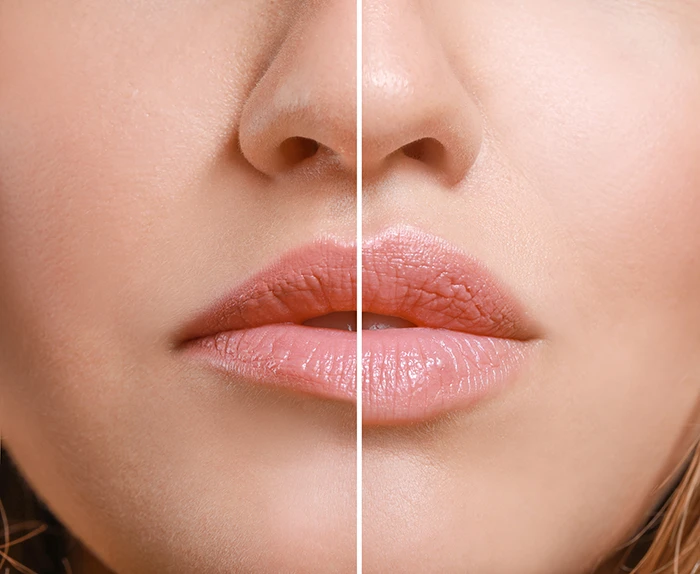 Close-up of a woman's lips and nose split in half, showing dry lips on the left and moisturized lips on the right.