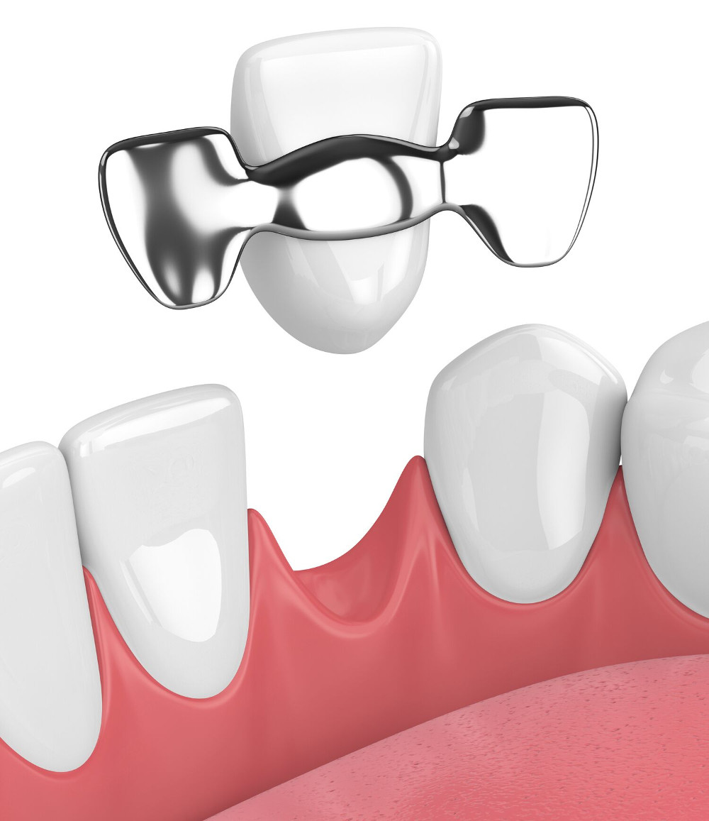 3D illustration of a dental bridge being positioned over a gap between teeth on pink gums.