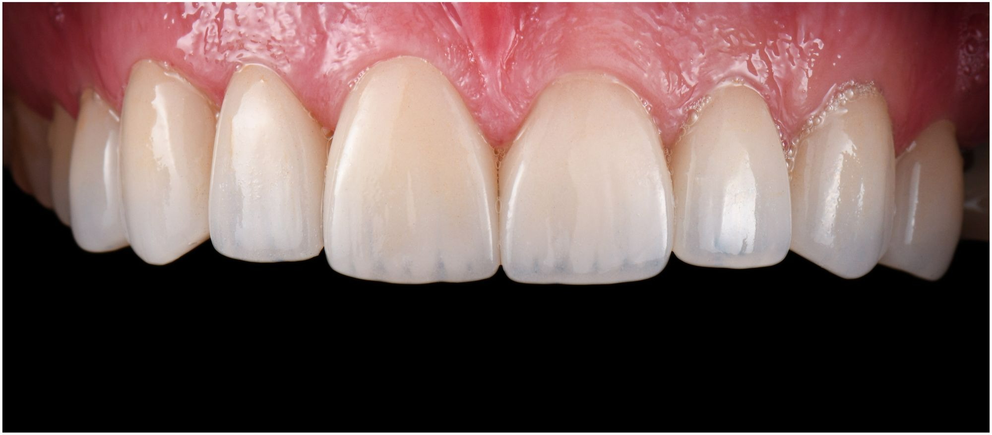 Close-up of healthy, clean upper front teeth and pink gums against a black background.