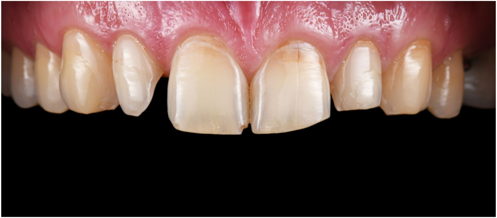 Close-up of upper front teeth with visible yellow discoloration and minor damage on two central incisors.