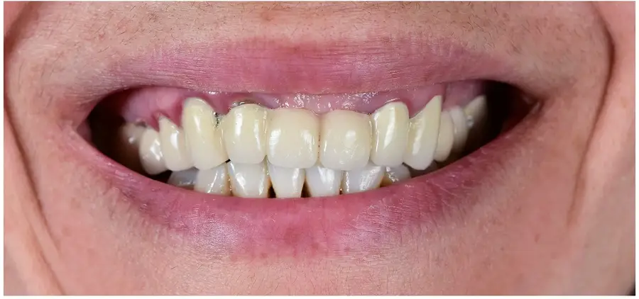 Close-up of a smiling mouth showing teeth with dental crowns and some visible gum inflammation.