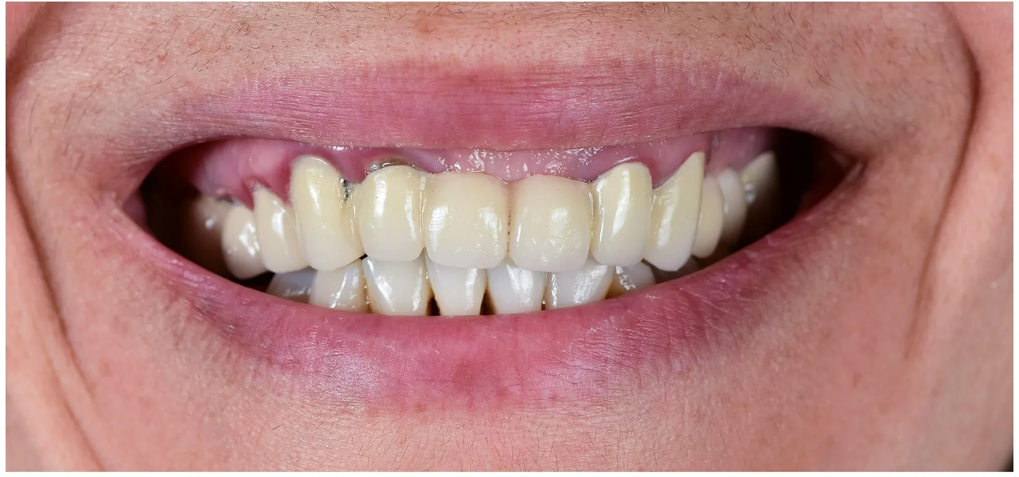 Close-up of a smiling mouth showing teeth with dental crowns and some visible gum inflammation.