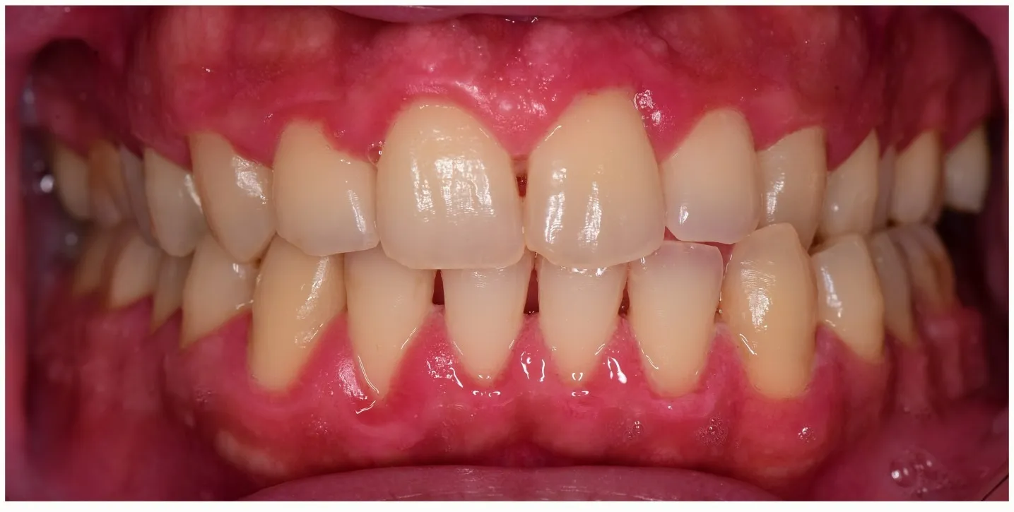 Close-up of upper and lower human teeth with visible gums showing dental misalignment and plaque buildup.