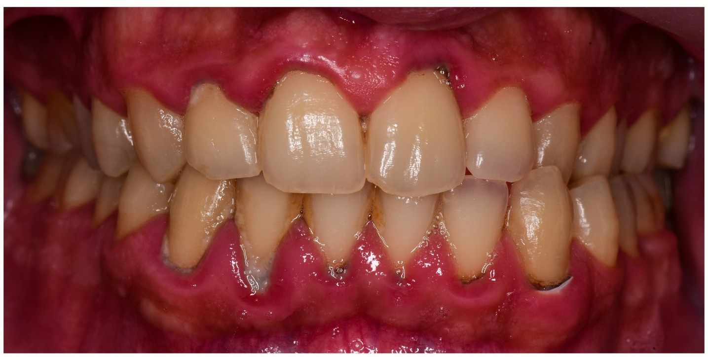 Close-up of teeth showing signs of gum inflammation and plaque buildup around the gums.