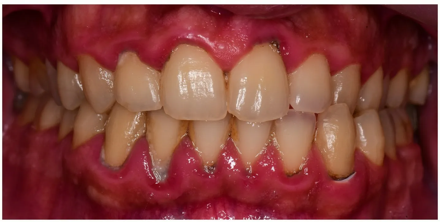 Close-up of teeth showing signs of gum inflammation and plaque buildup around the gums.