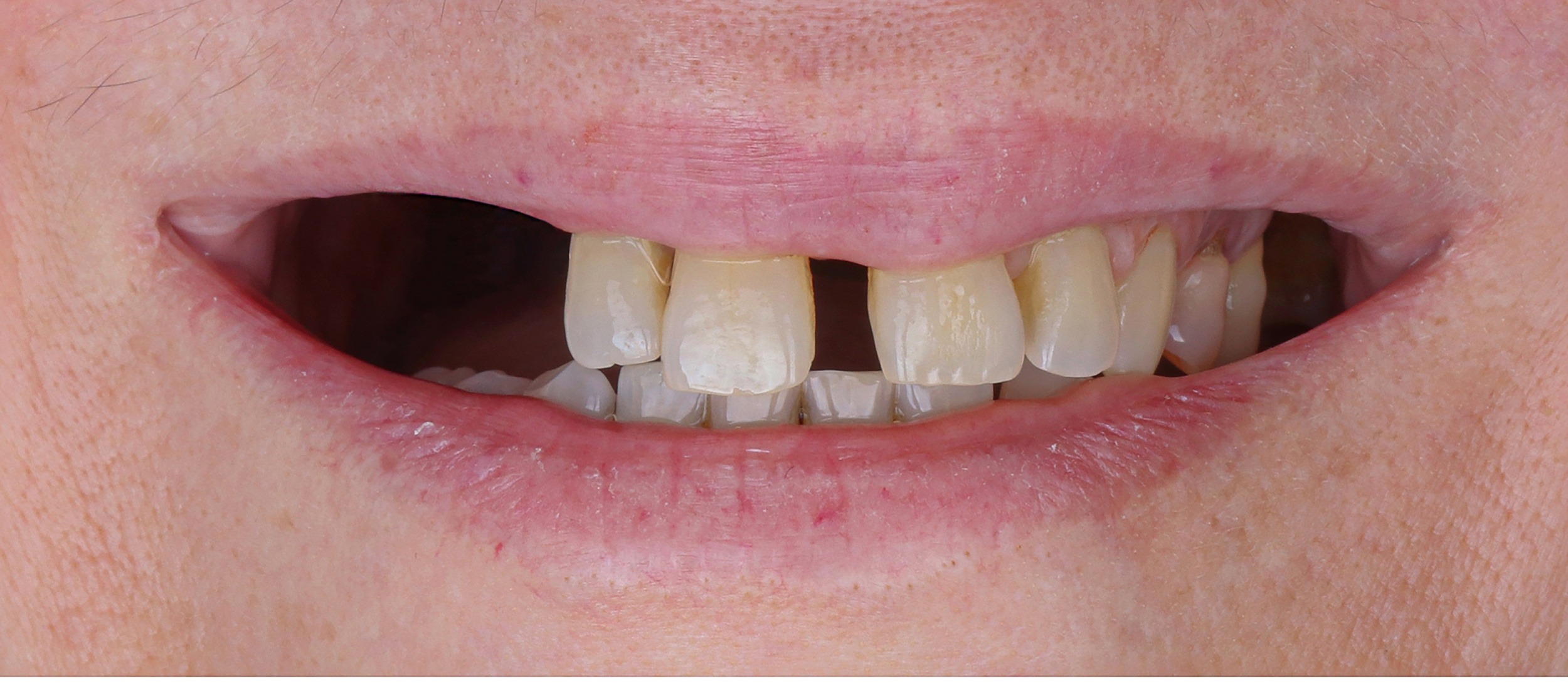 Close-up of a mouth with slightly parted lips showing stained and misaligned upper teeth with gaps.