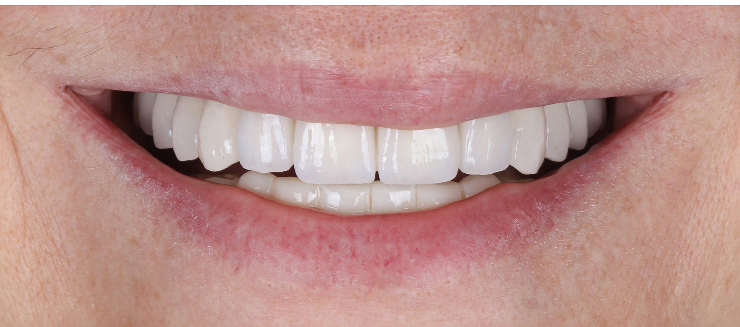 Close-up of a smiling mouth showing clean, white teeth and natural lips.