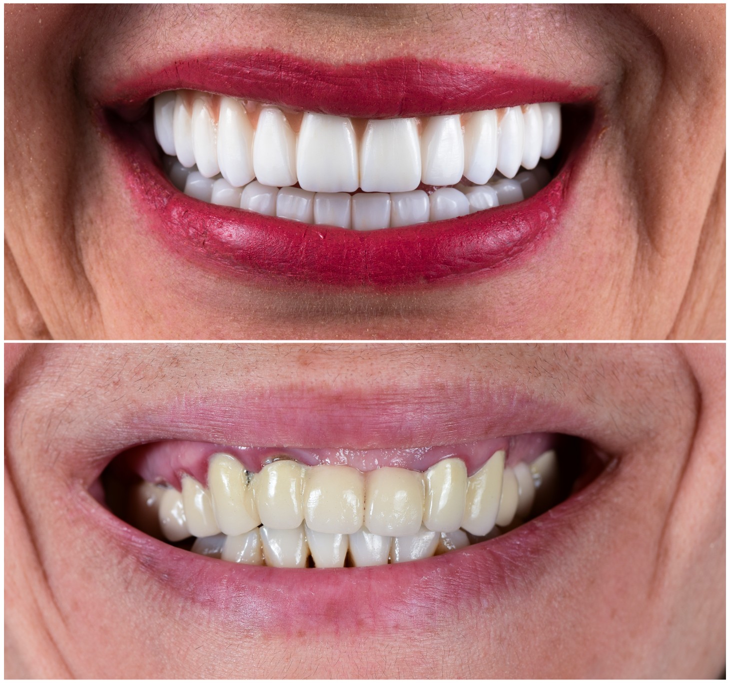 Smile makeovers