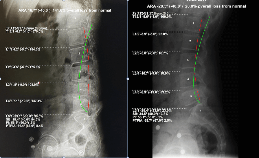 Advanced Corrective Chiropractic X Ray