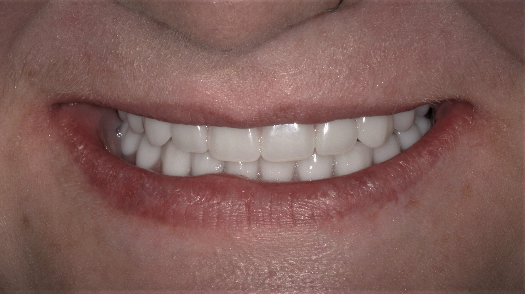 Close-up of a person smiling showing straight, white teeth and natural lips.