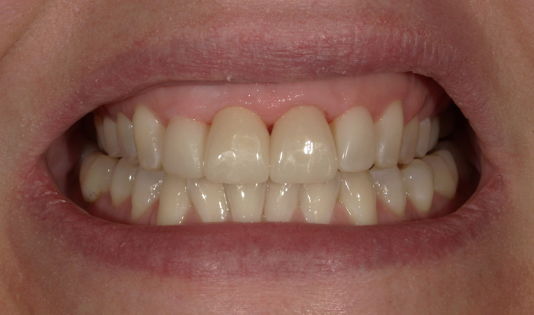 Close-up of a person's smile showing clean, well-aligned teeth and healthy gums.