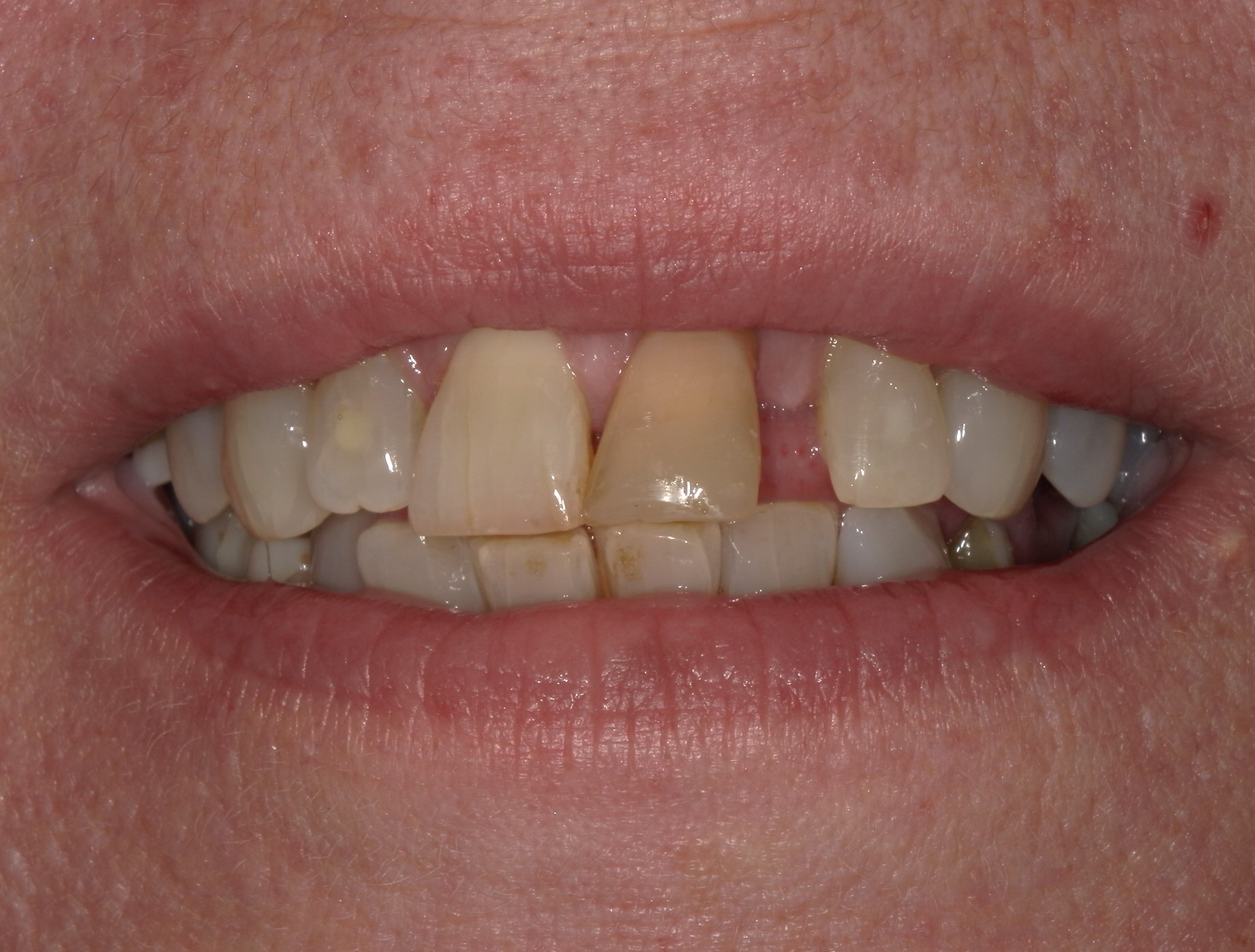 Close-up of human teeth with discoloration, plaque stains, and a missing front tooth.