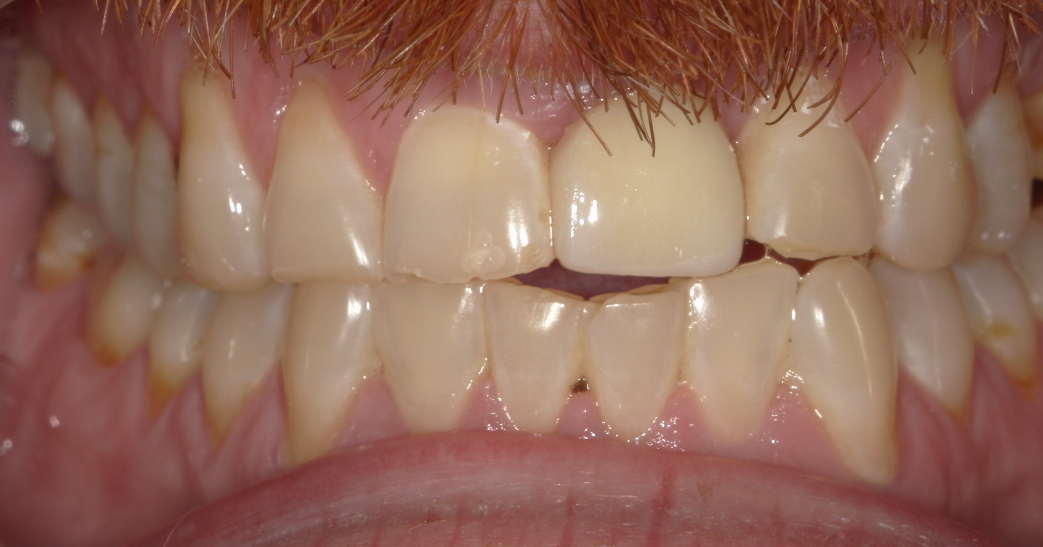 Close-up of upper and lower front teeth with a dental implant visible on the upper right central incisor and minor discoloration on some teeth.