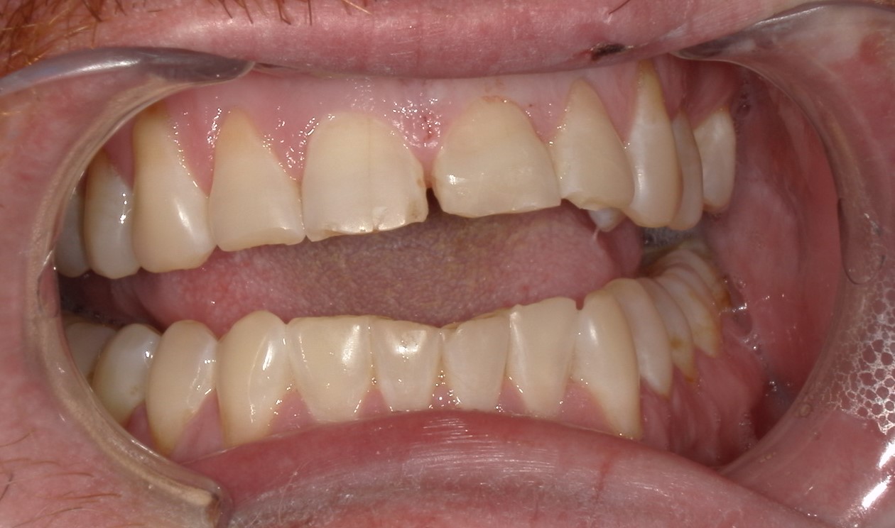Close-up of an open mouth showing chipped and worn upper front teeth with natural lower teeth.