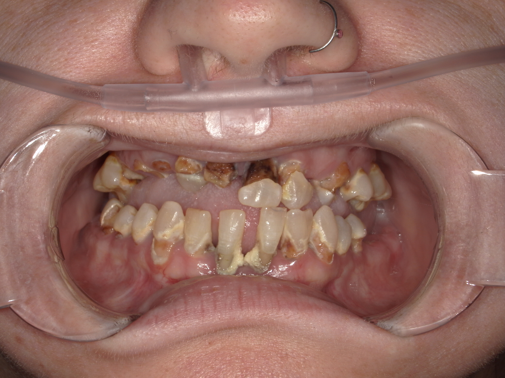 Close-up of a person's mouth showing severely decayed and discolored teeth with a nasal cannula in place.
