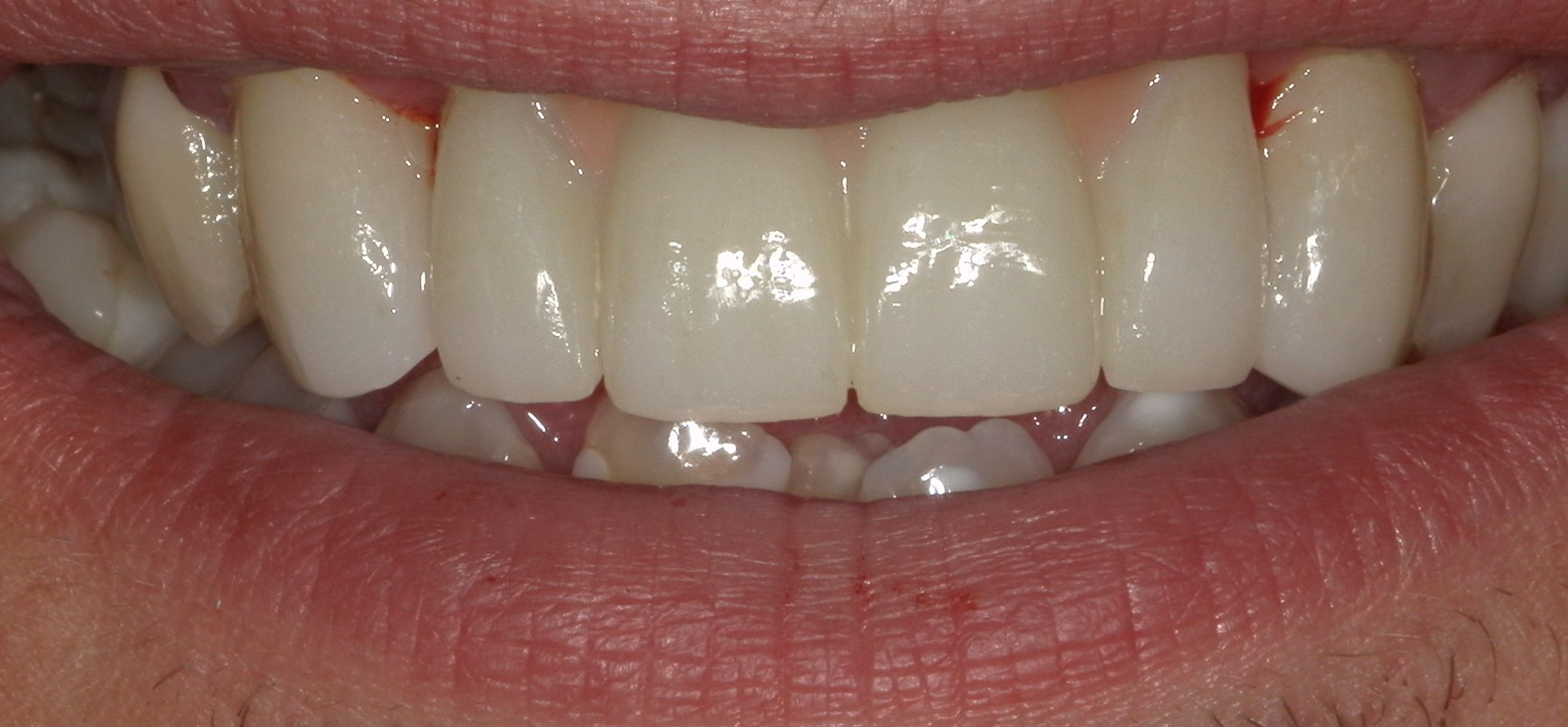 Close-up of a person's smile showing upper and lower teeth, with slight redness on the gums near upper teeth.