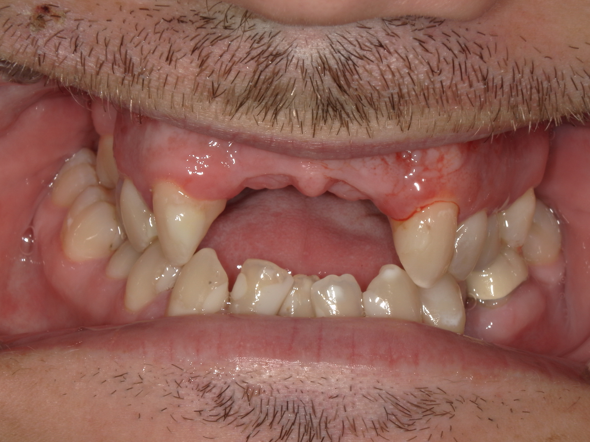 Close-up of a person's mouth showing missing upper front teeth and inflamed gums.