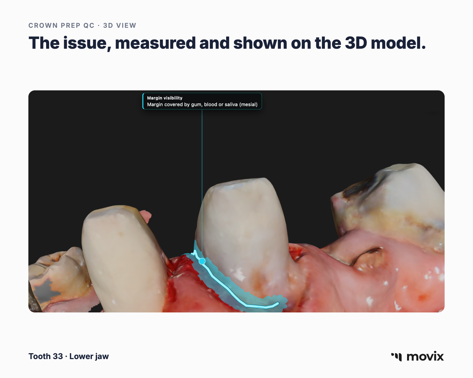 3D model of a crown prep scan, tooth 33, with the margin line highlighted where it is covered by gum, blood or saliva.