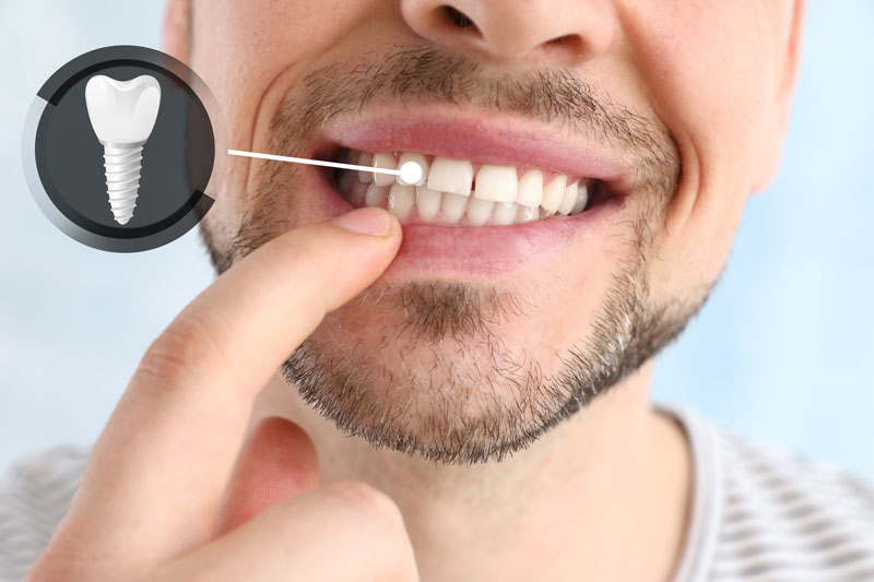 Benefits of All-on-X Dental Implants