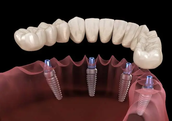 A More Stable Alternative to Traditional Dentures