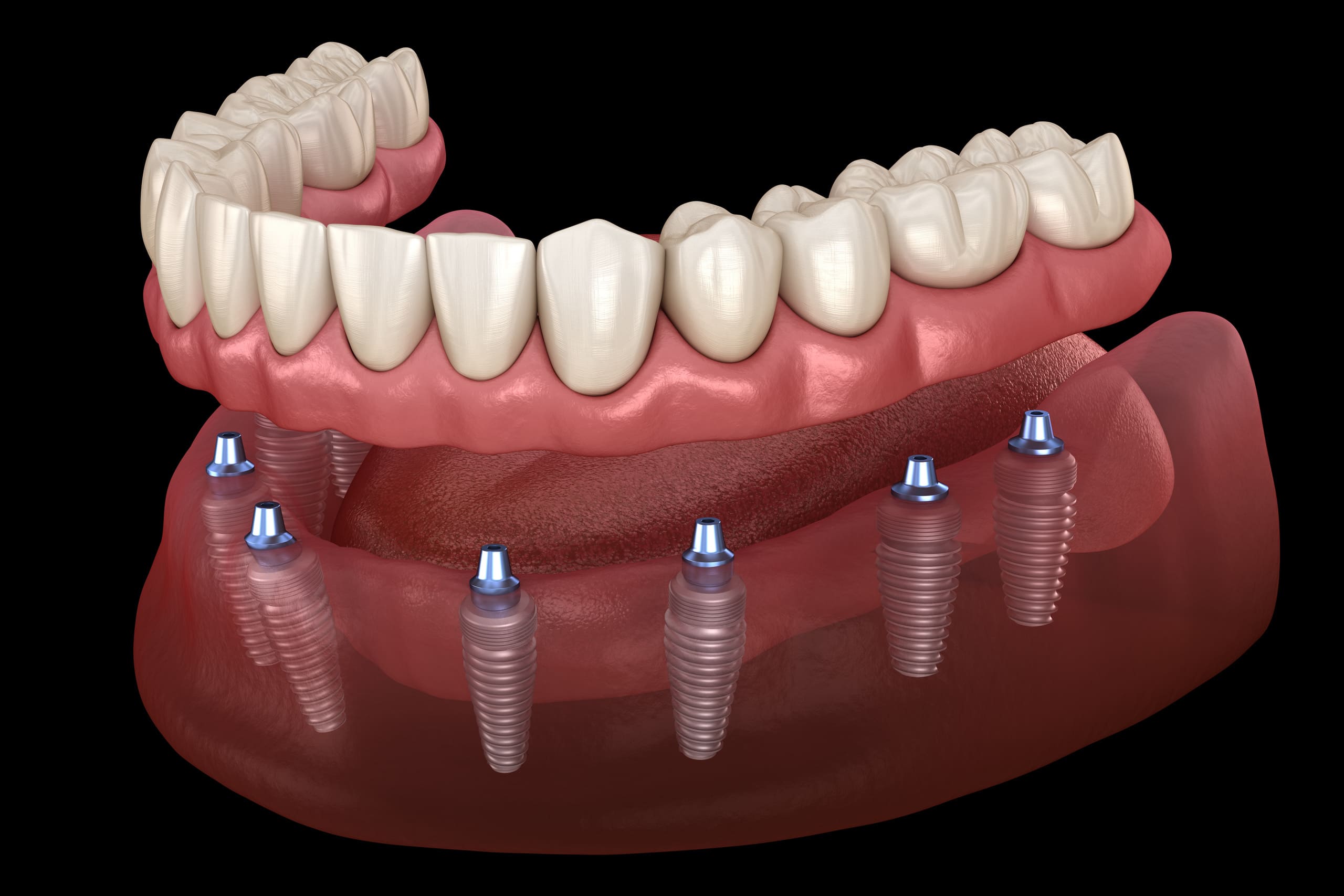 Implant Supported Dentures in Lake Nona, FL