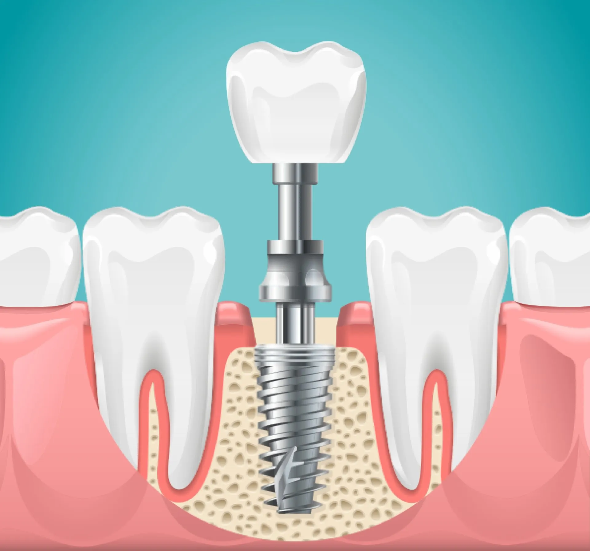 What Is Zirconia?