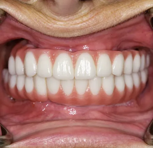 Close-up of Teresa's teeth after treatment