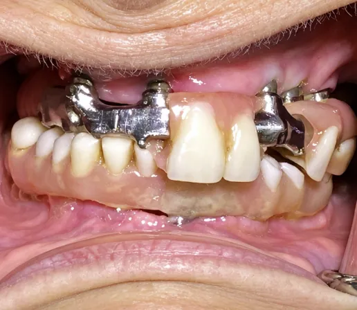 Close-up of Teresa's teeth before treatment