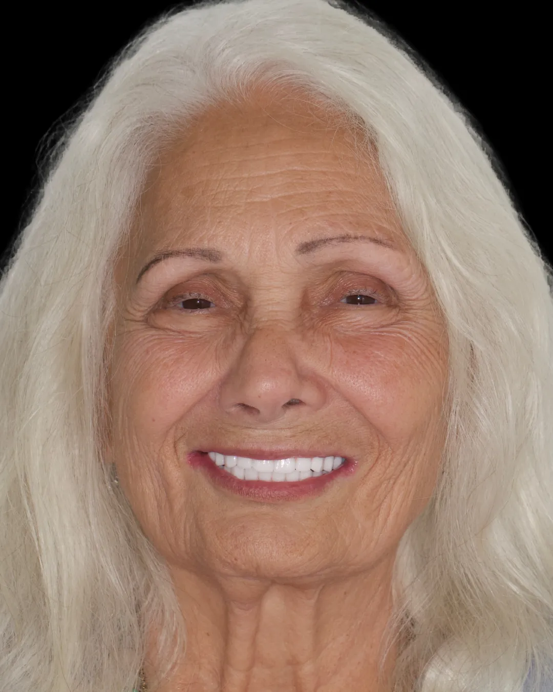 Teresa after treatment, front view of the new smile