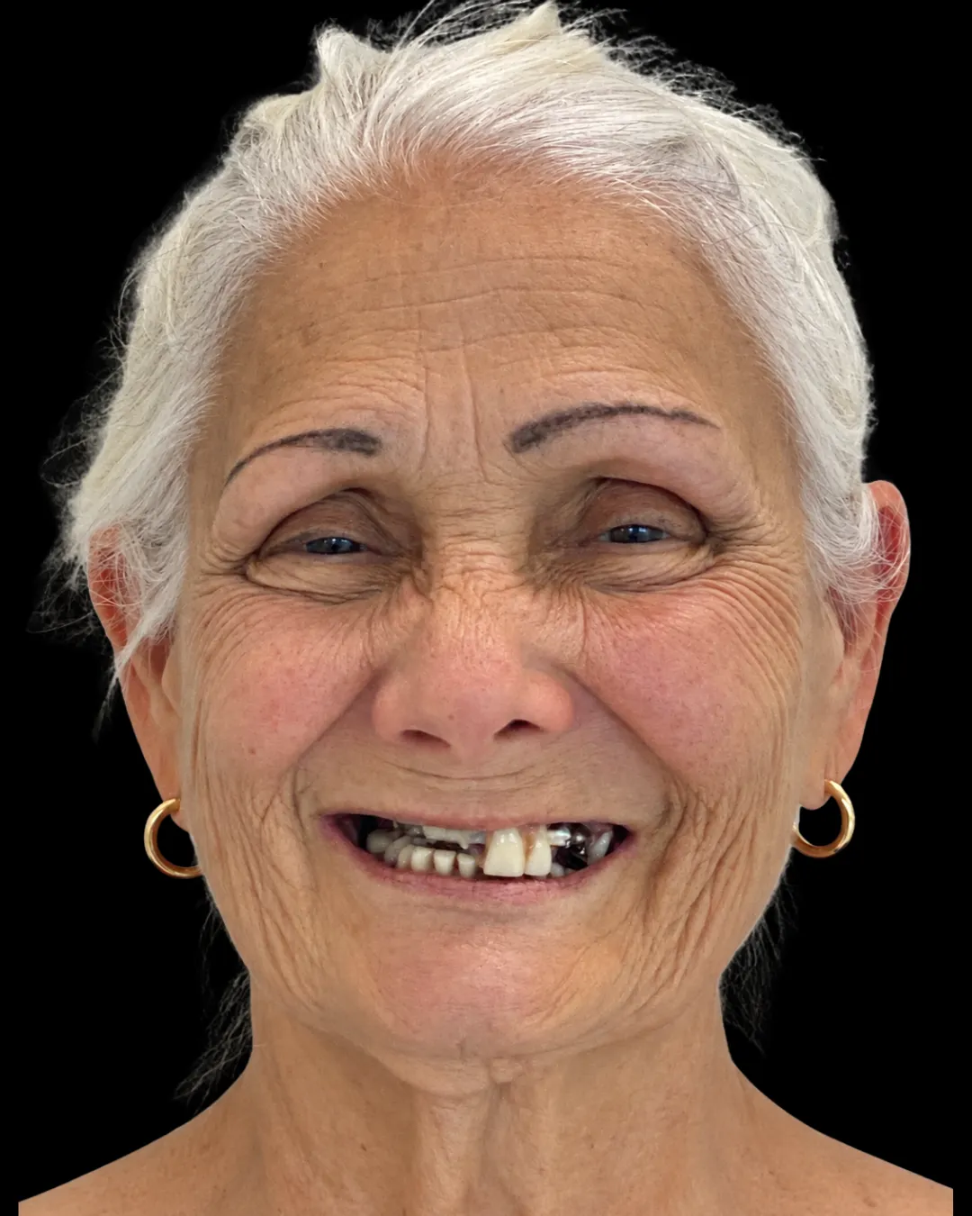 Teresa before treatment, front view of the smile