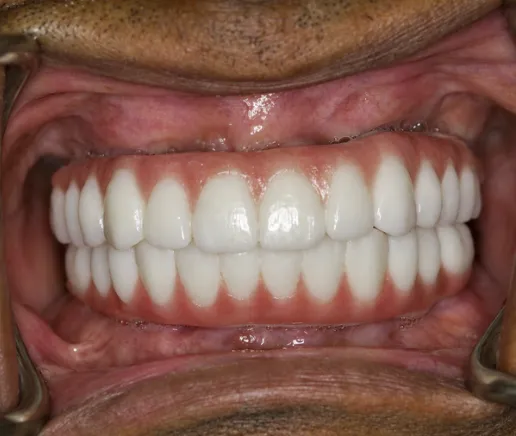 Close-up of Tamesh's teeth after treatment