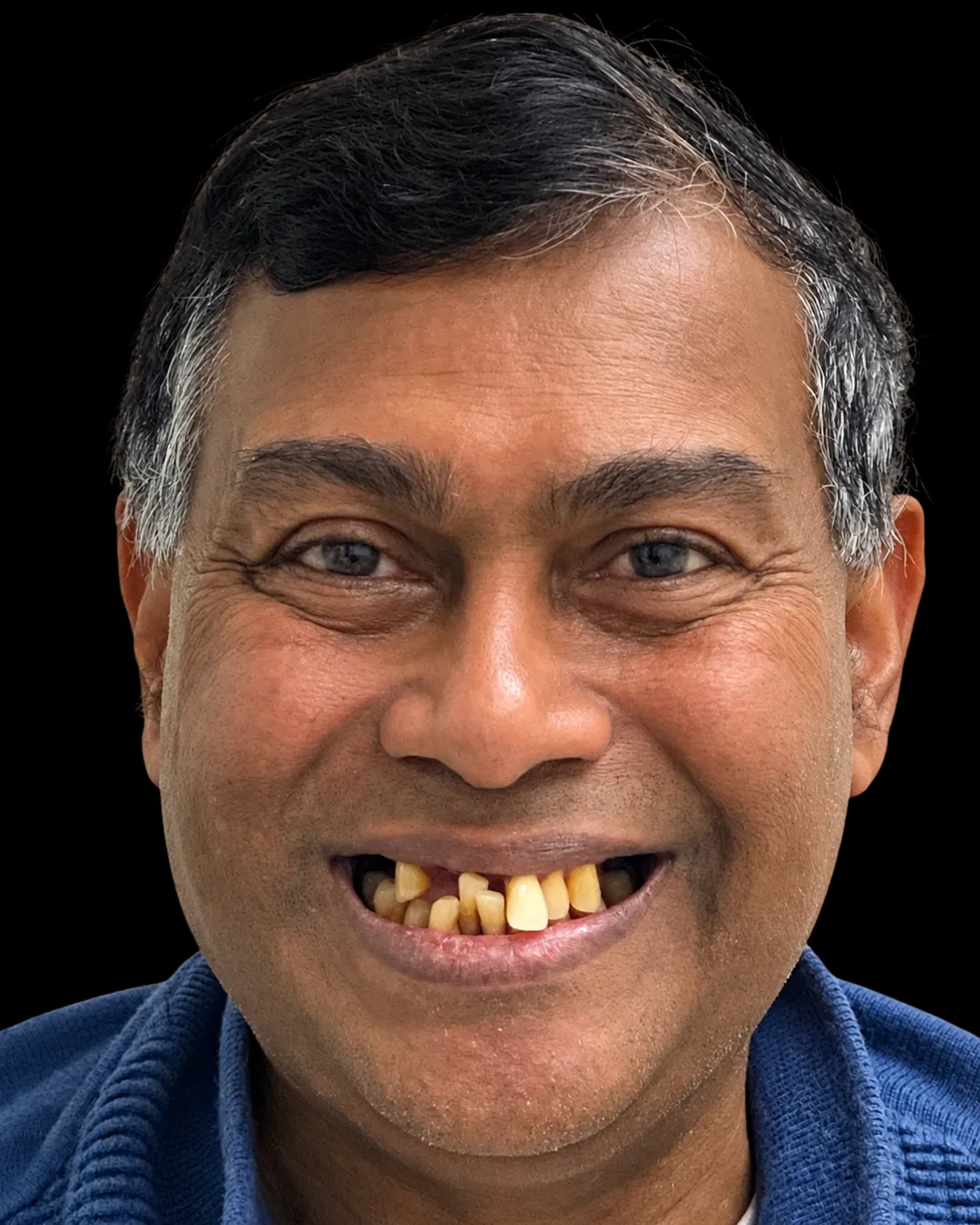Tamesh before treatment, front view of the smile