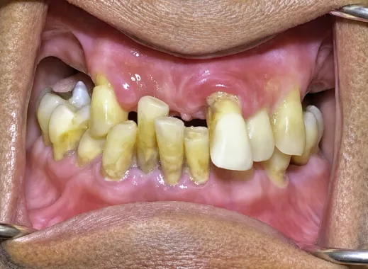 Close-up of Tamesh's teeth before treatment