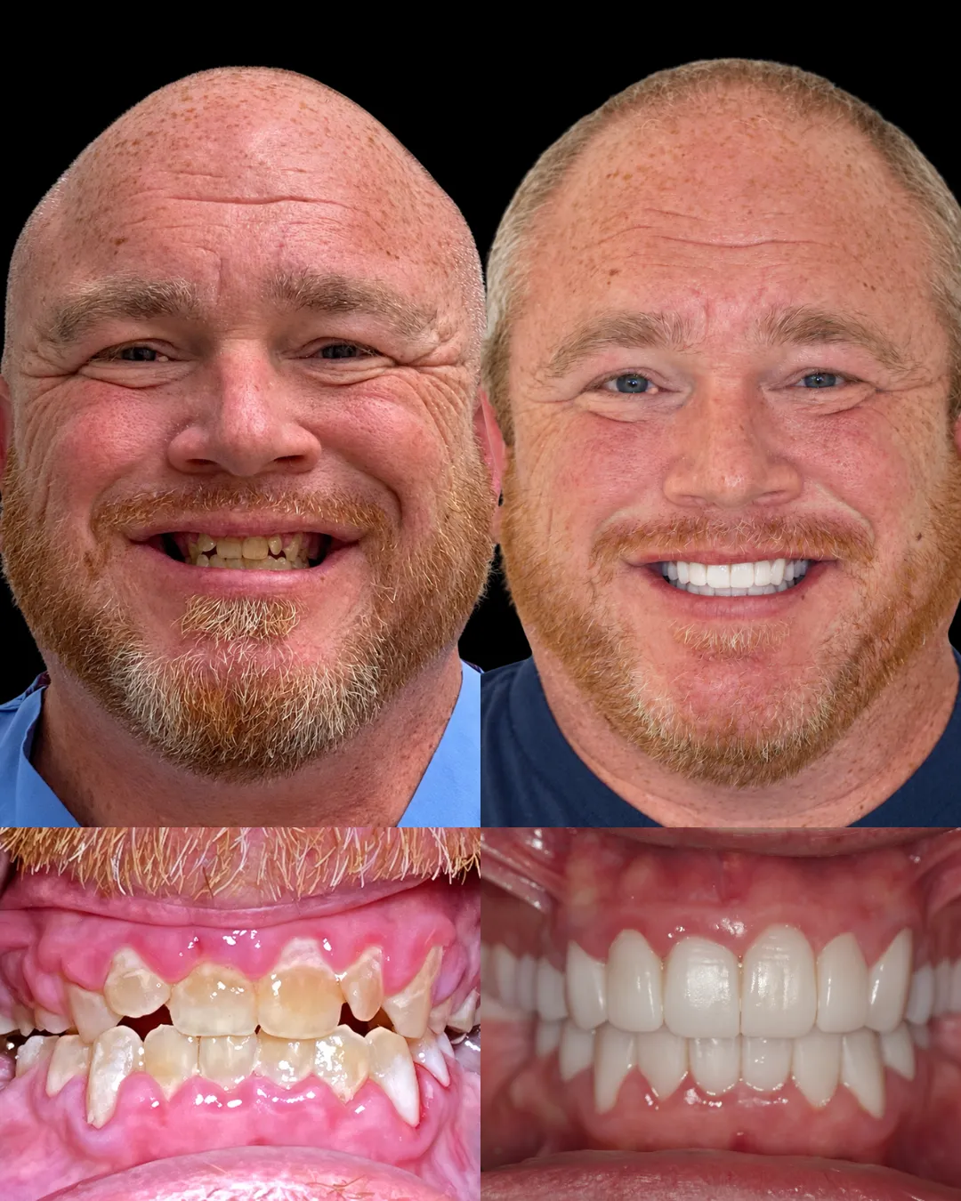 Patient Hunter before and after full-mouth reconstruction with custom crowns at Makris Dental