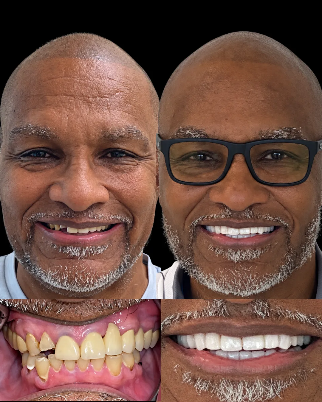 Patient before and after full-mouth custom crown restoration