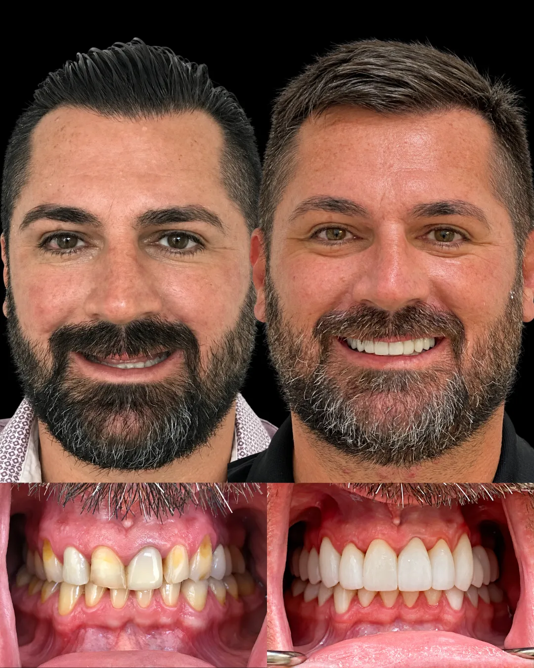 Patient before and after full-mouth reconstruction with custom crowns