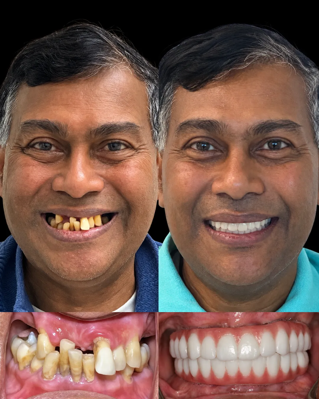 Patient before and after full-mouth All-on-X dental implant treatment