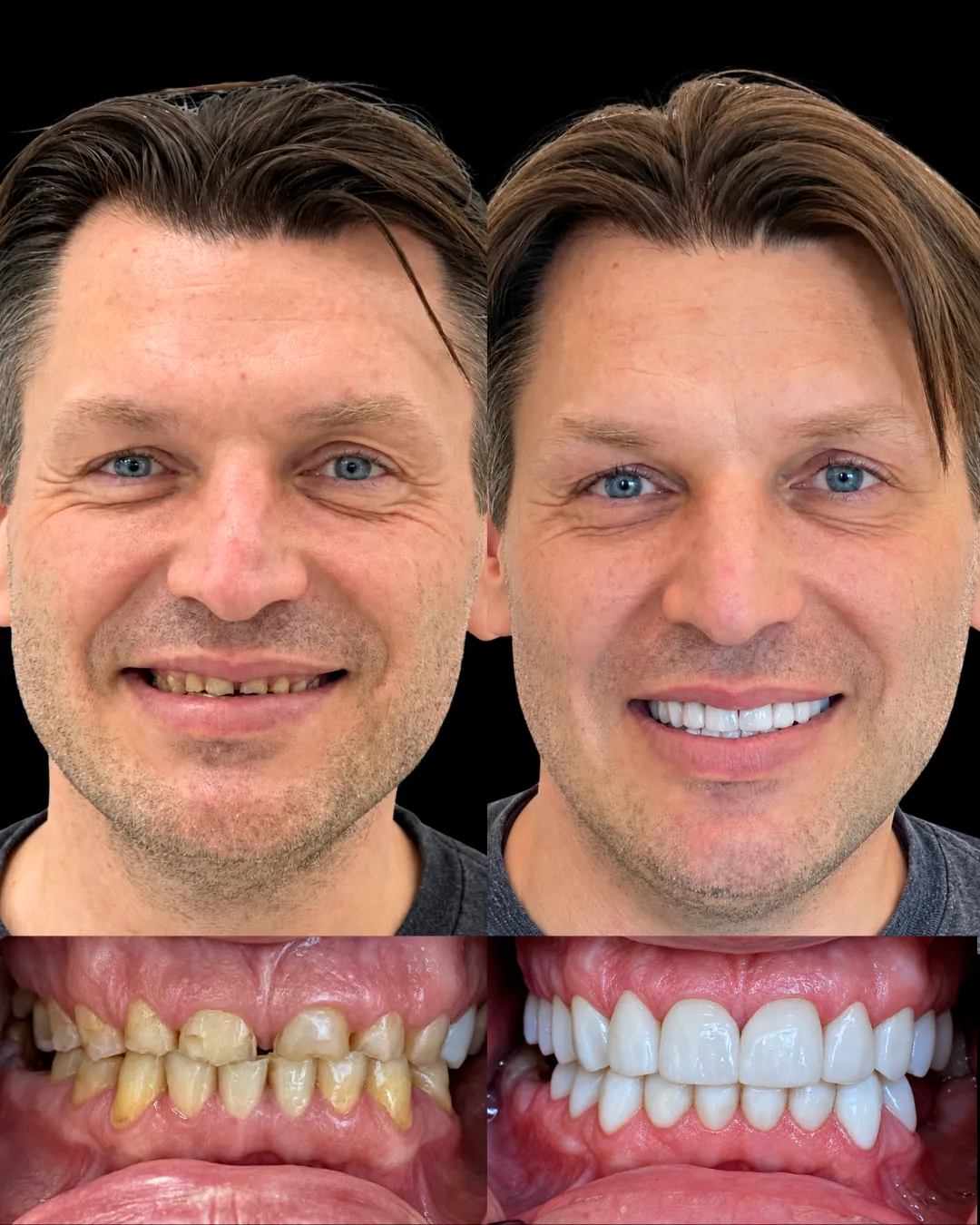 Patient Rosa before and after custom veneers, bridges, and crowns smile makeover