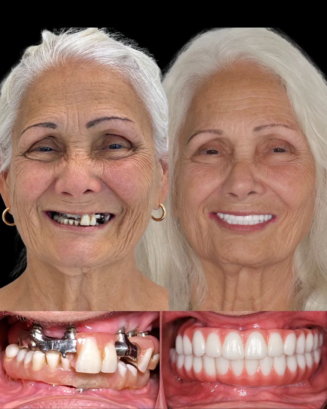Patient before and after revision of failed All-on-X hybrid restoration