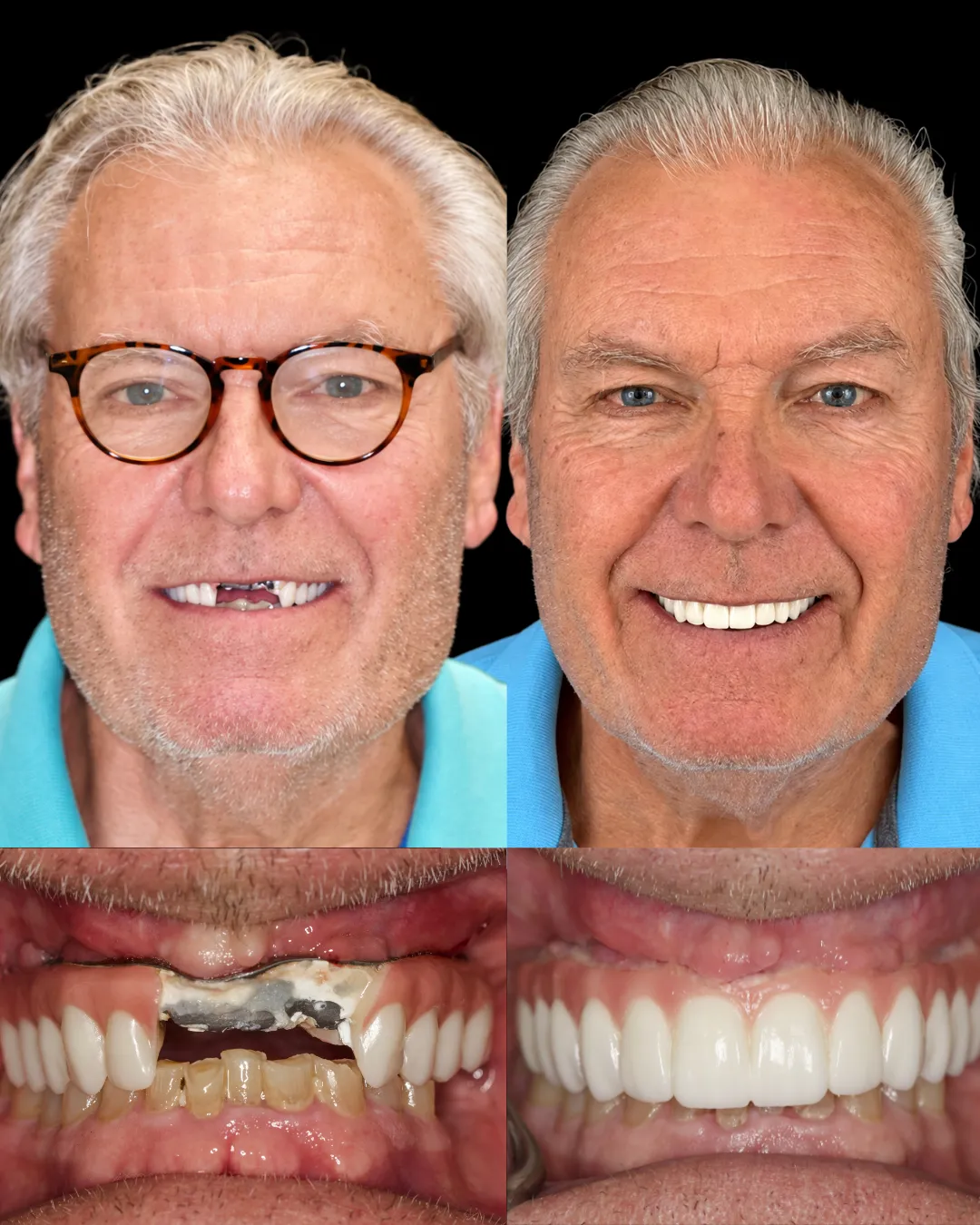 Patient Bruce before and after corrected All-on-X zirconia hybrid restoration