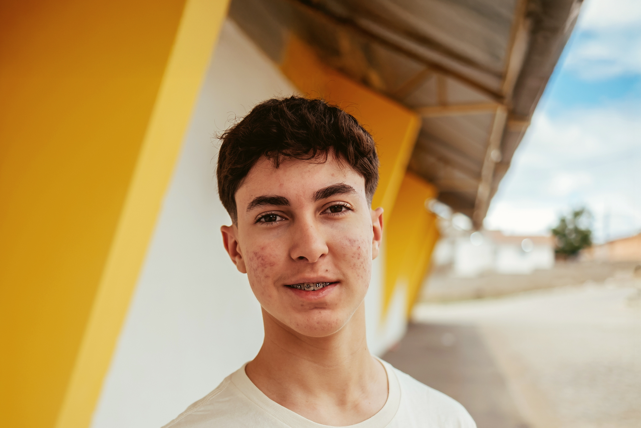 Close-up of a person's cheek with acne blemishes and a finger gently touching the skin.