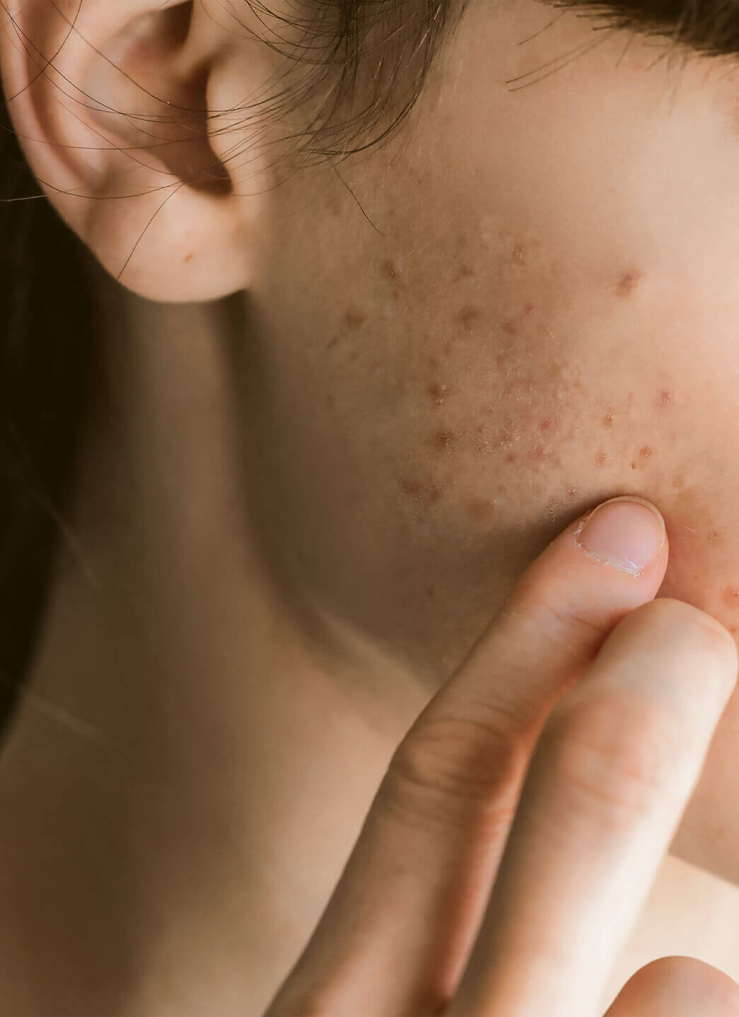 Close-up of a person's cheek with acne blemishes and a finger gently touching the skin.