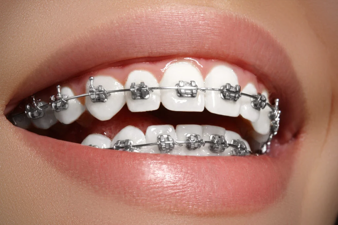image of a patient with metal braces