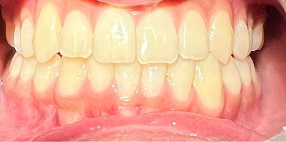 Close-up of upper and lower teeth showing slight discoloration with healthy pink gums.