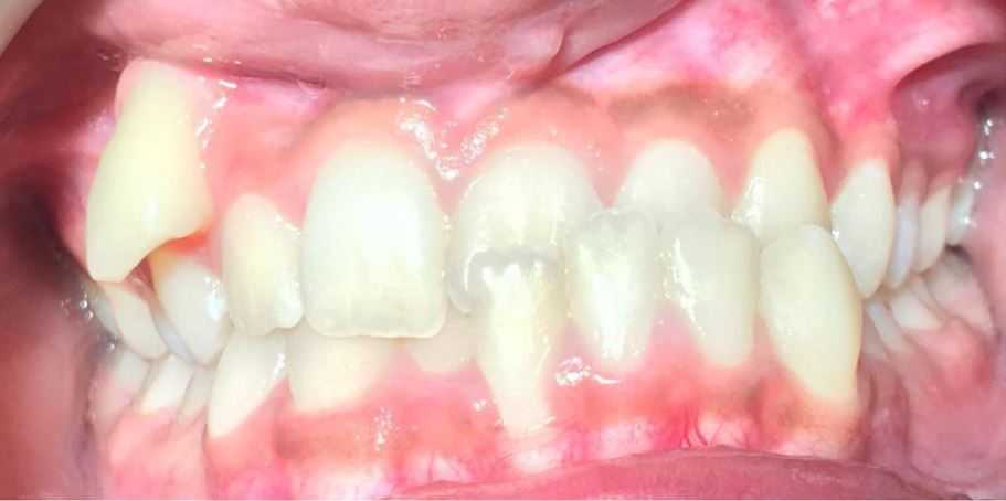 Close-up of upper and lower teeth with noticeable discoloration and irregular alignment.