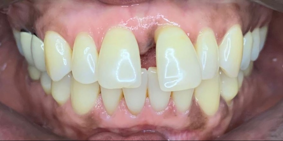 Close-up of a person's upper and lower teeth showing a missing upper front tooth and yellow discoloration on adjacent teeth.