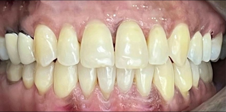 Close-up of human teeth showing natural coloration and alignment with some yellowing and receding gums.