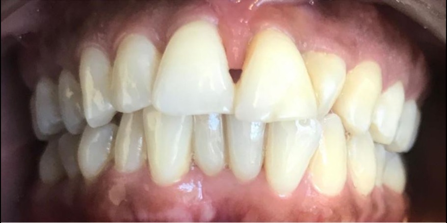 Close-up of human teeth showing an uneven upper front tooth with a gap, and slightly misaligned lower teeth.